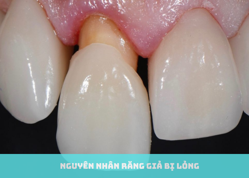 Nguyên Nhân Răng Giả Bị Lỏng