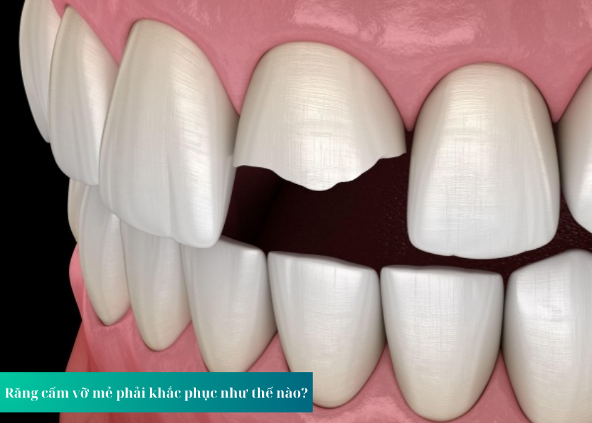 Răng cấm vỡ mẻ phải khắc phục như thế nào ?
