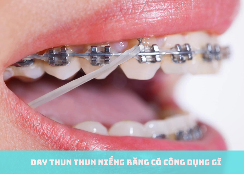 Thun niềng răng có công dụng gì