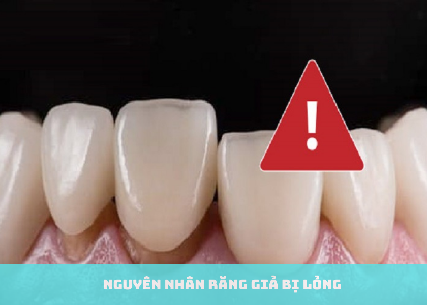 Nguyên Nhân Răng Giả Bị Lỏng