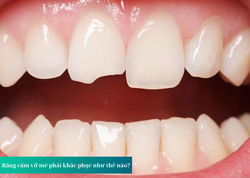 Răng cấm vỡ mẻ phải khắc phục như thế nào ?