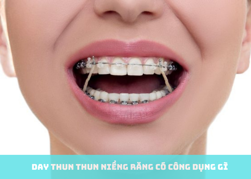 Thun niềng răng có công dụng gì