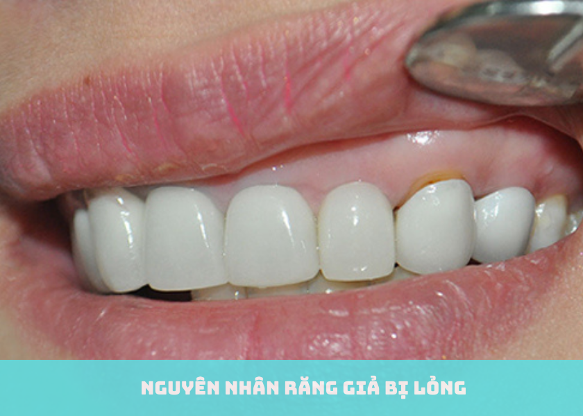 Nguyên Nhân Răng Giả Bị Lỏng