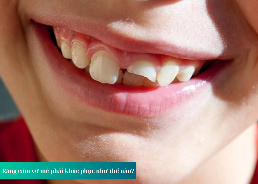 Những nguyên nhân khiến răng cấm vỡ mẻ