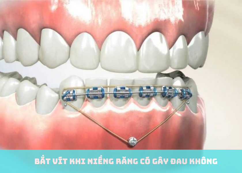 Bắt vít khi niềng răng có gây đau không