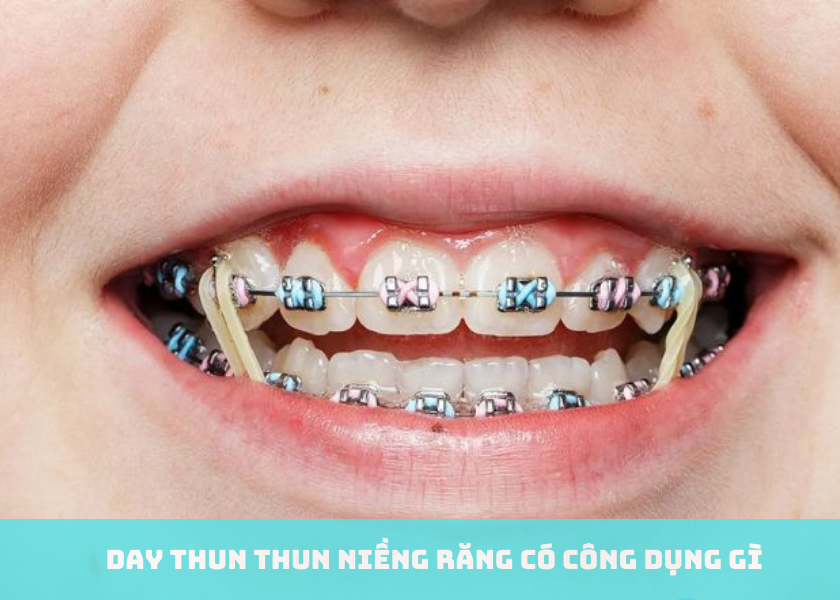 Thun niềng răng có công dụng gì