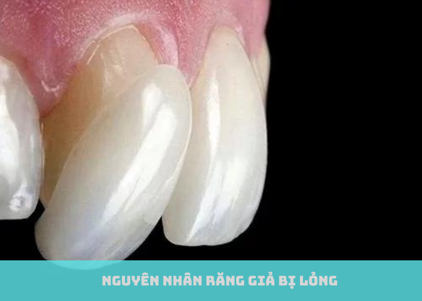 Nguyên Nhân Răng Giả Bị Lỏng