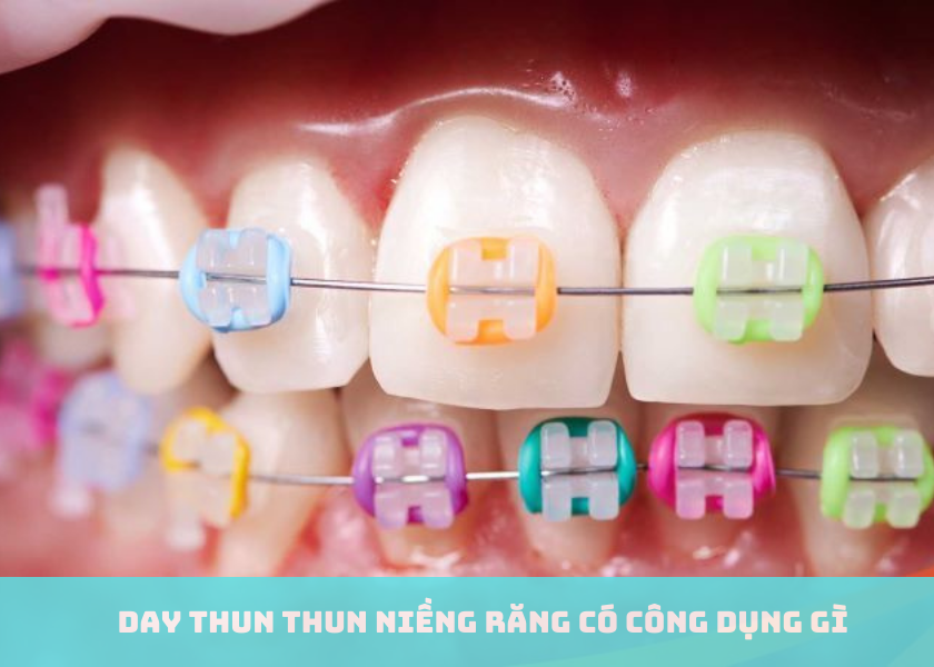 Thun niềng răng có công dụng gì