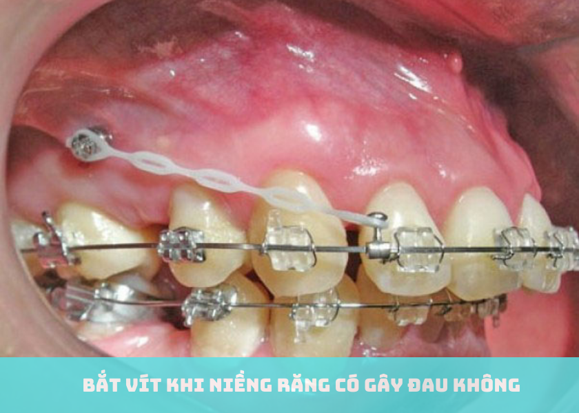 Bắt vít khi niềng răng có gây đau không