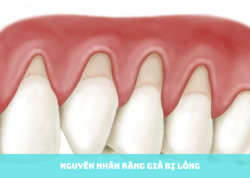 Nguyên Nhân Răng Giả Bị Lỏng