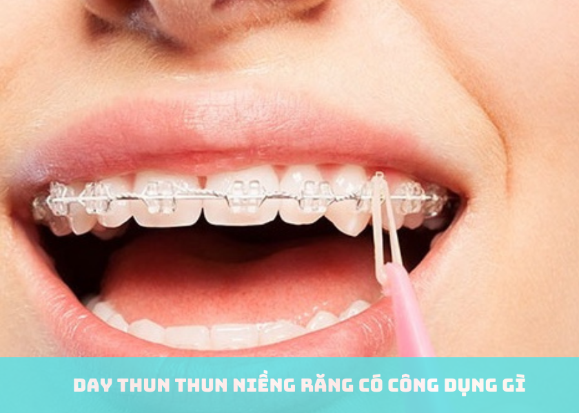 Thun niềng răng có công dụng gì