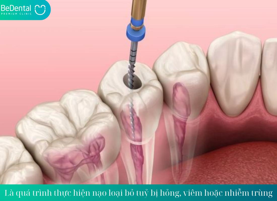 Tìm hiểu về phương pháp lấy tủy răng cấm