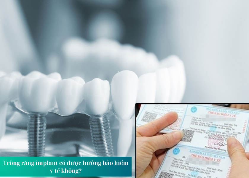 Trồng răng implant có được hưởng bảo hiểm y tế không?