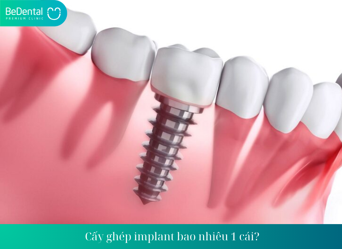 Cay ghep implant bao nhieu 1 cai