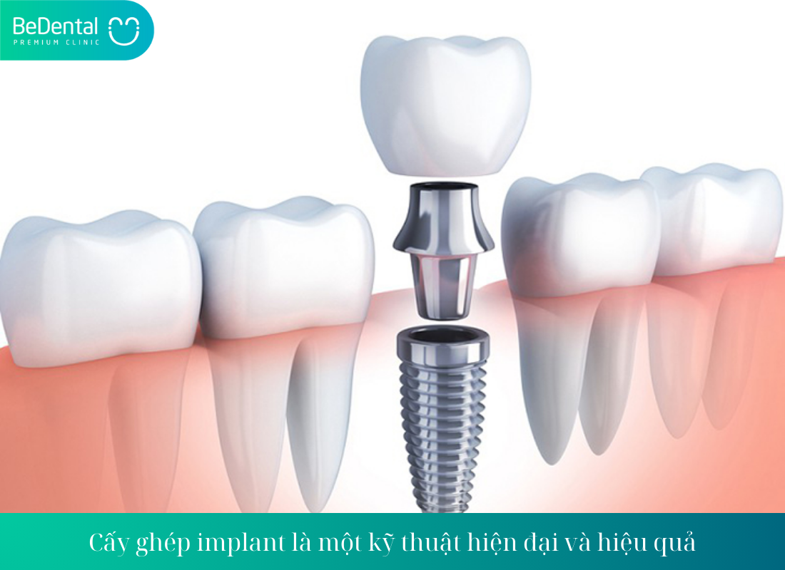 Sau Khi Trồng Răng Implant Có Niềng Được Không