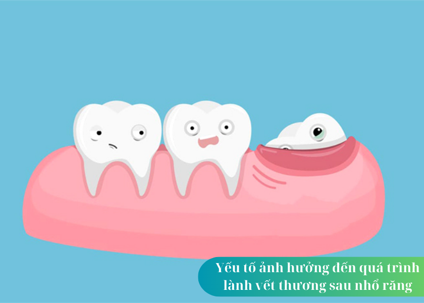 Nhổ răng khôn bao lâu thì lành? Nhổ răng khôn xong có được đánh răng không? Nhổ răng khôn làm sao hết đau?