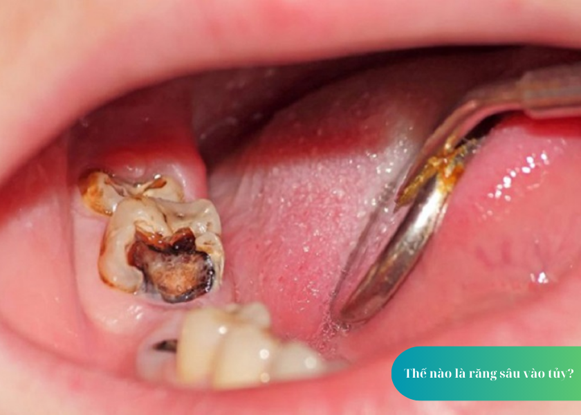 1 số cách điều trị lỗ sâu răng vào tủy hiệu quả