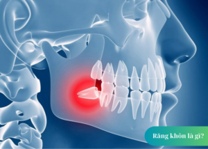 Review kinh nghiệm nhổ răng khôn tại BeamDental