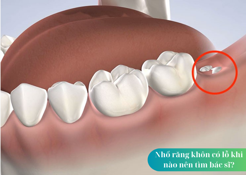 Nguyên nhân dẫn đến mọc răng khôn hàm trên là gì?