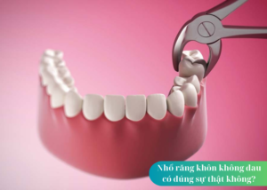 Nhổ răng khôn không đau có đúng sự thật không?