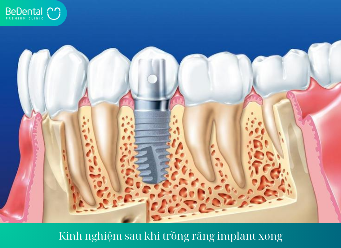 Kinh nghiem sau khi trong rang implant