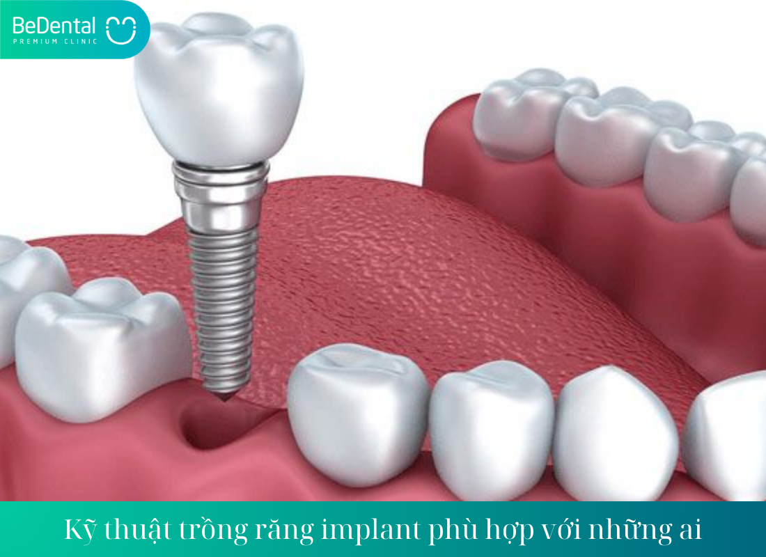 trồng răng implant là gì?