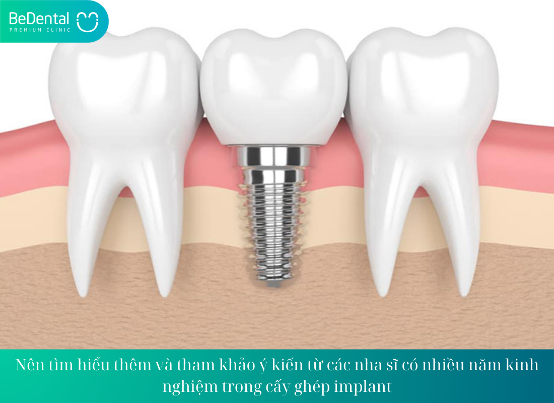 Trồng Răng Implant Ở Đâu Uy Tín