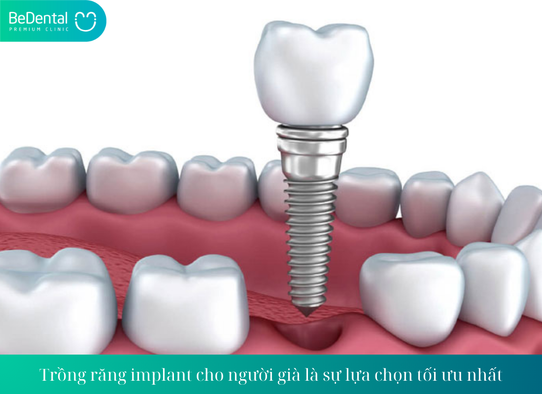 Trong rang implant cho nguoi gia la su lua chon toi uu nhat