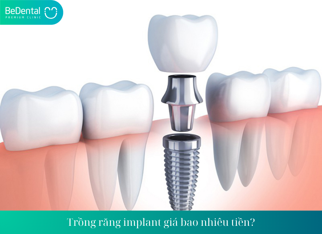 Trong rang implant gia bao nhieu tien