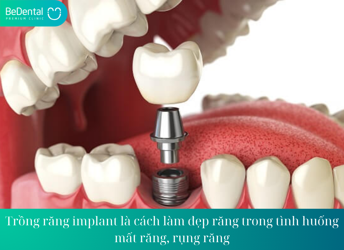 Trong rang implant la cach lam dep rang trong tinh huong mat rang rung rang