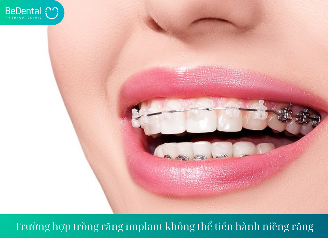 Truong hop trong rang implant khong the tien hanh nieng rang