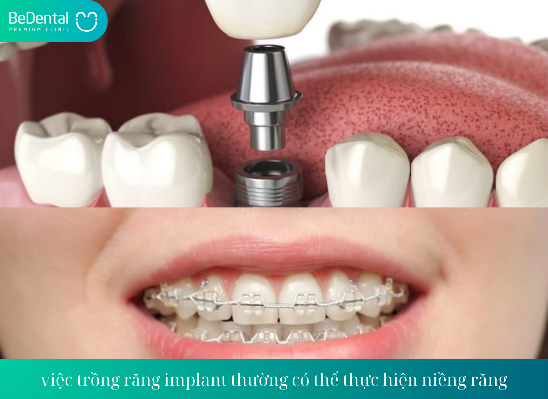 viec trong rang implant thuong co the thuc hien nieng rang