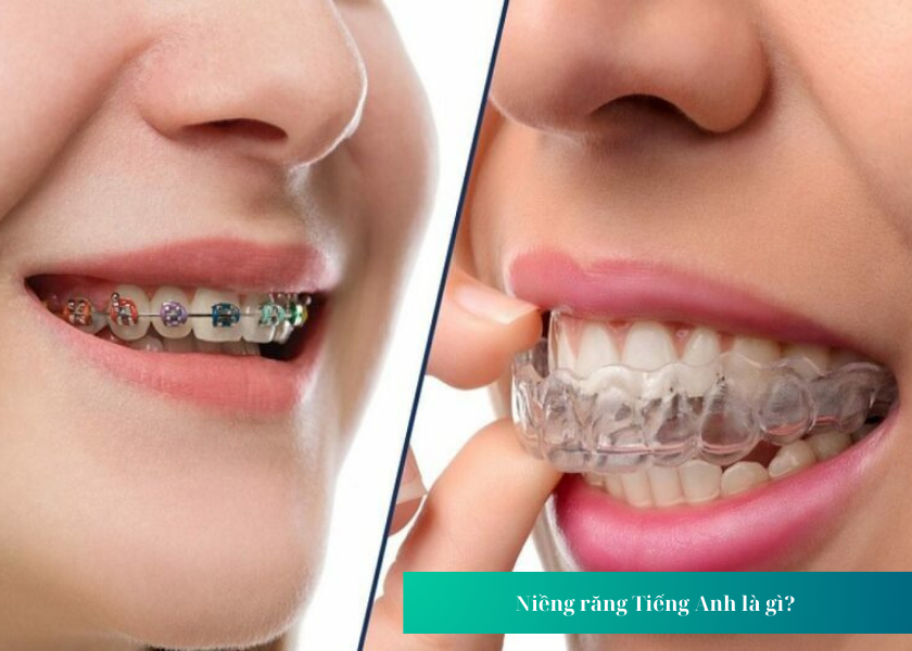 Niềng răng tiếng Anh và tiếng Việt có khác biệt nhau không? 