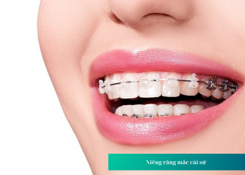 Có các loại niềng răng nào?
