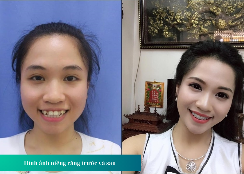 Hình ảnh niềng răng trước và sau