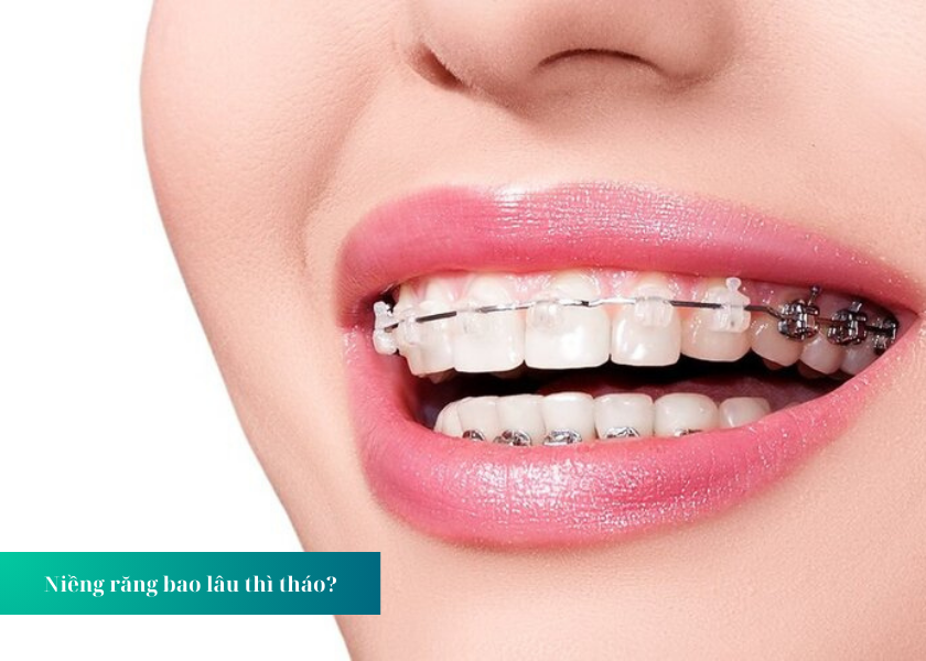 Niềng răng bao lâu thì tháo?