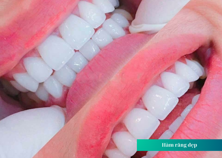 Các dáng răng sứ đẹp được ưa chuộng hiện nay