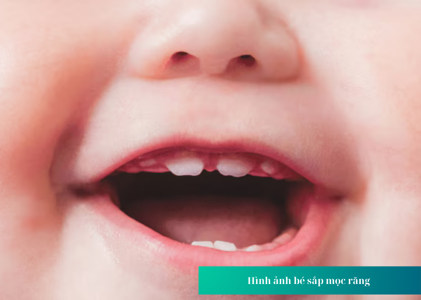 Dấu hiệu để biết bé mọc răng hàm 
