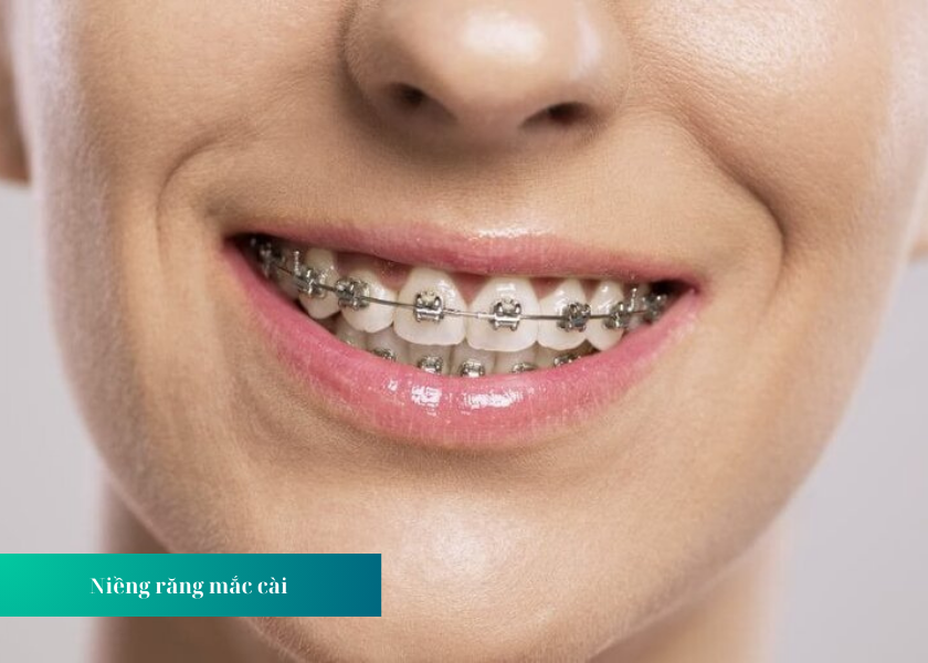 Chi phí niềng răng phụ thuộc vào các yếu tố nào?