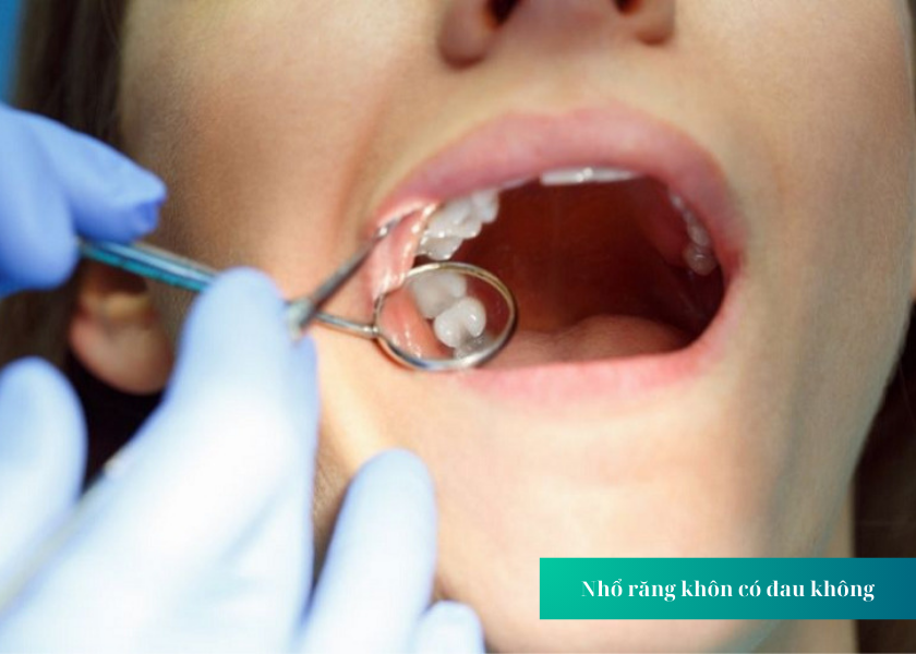 Những biến chứng nguy hiểm khi răng khôn phát triển bất thường 