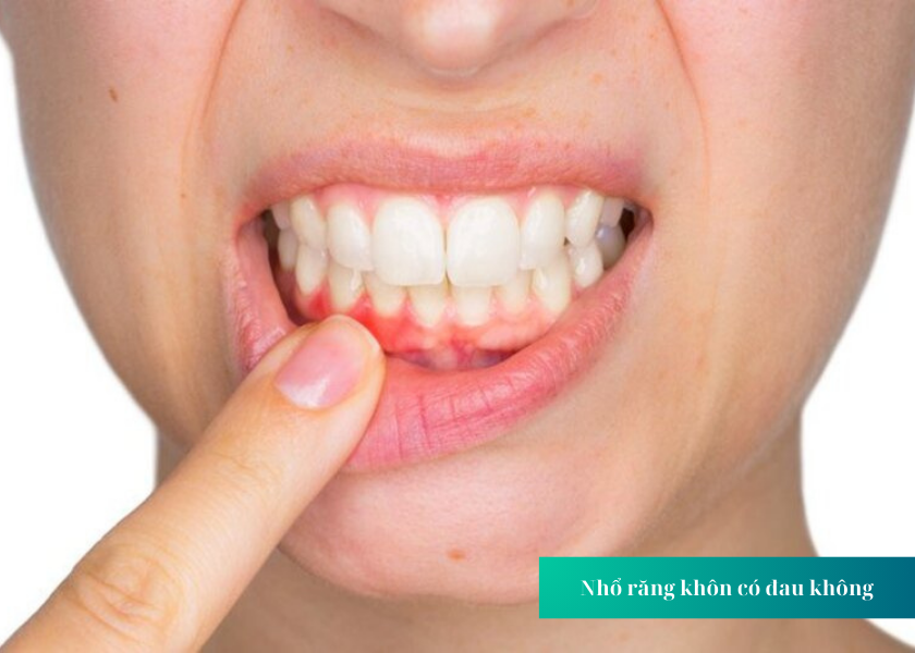 Tại sao cần loại bỏ răng khôn hàm trên?