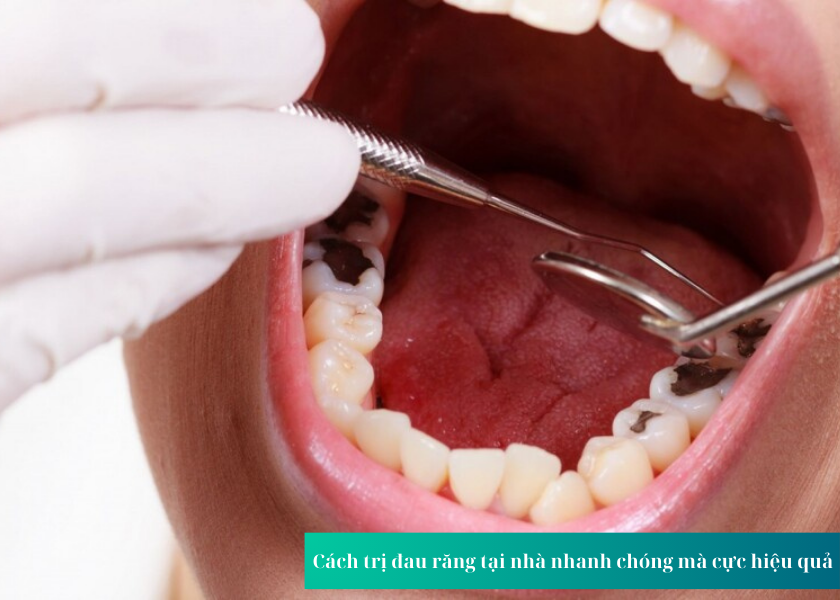  Cách trị đau răng tại nhà nhanh chóng mà cực hiệu quả 