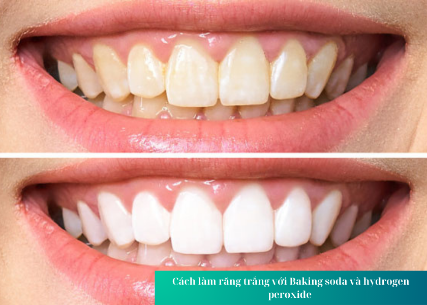 Cách làm răng trắng với Baking soda và hydrogen peroxide 