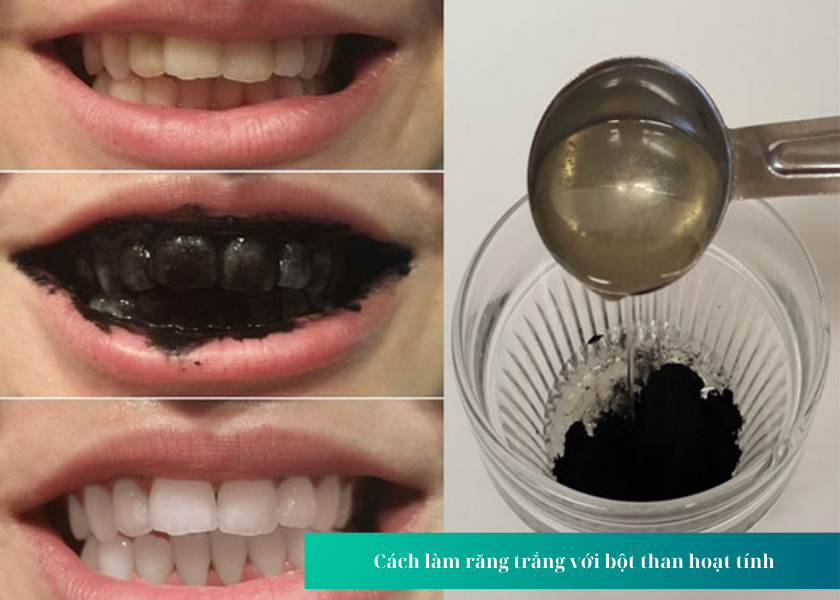  Cách làm răng trắng với bột than hoạt tính
