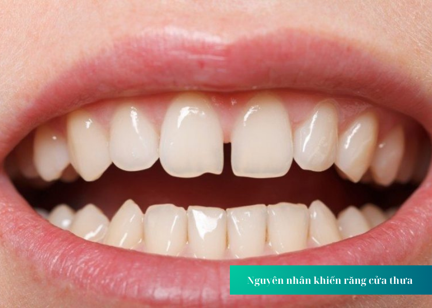 Răng thưa là gì? Nguyên nhân nào khiến răng bị thưa?