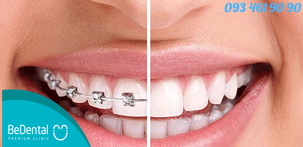 Góc nghiêng trước và sau khi niềng răng thay đổi như thế nào? 