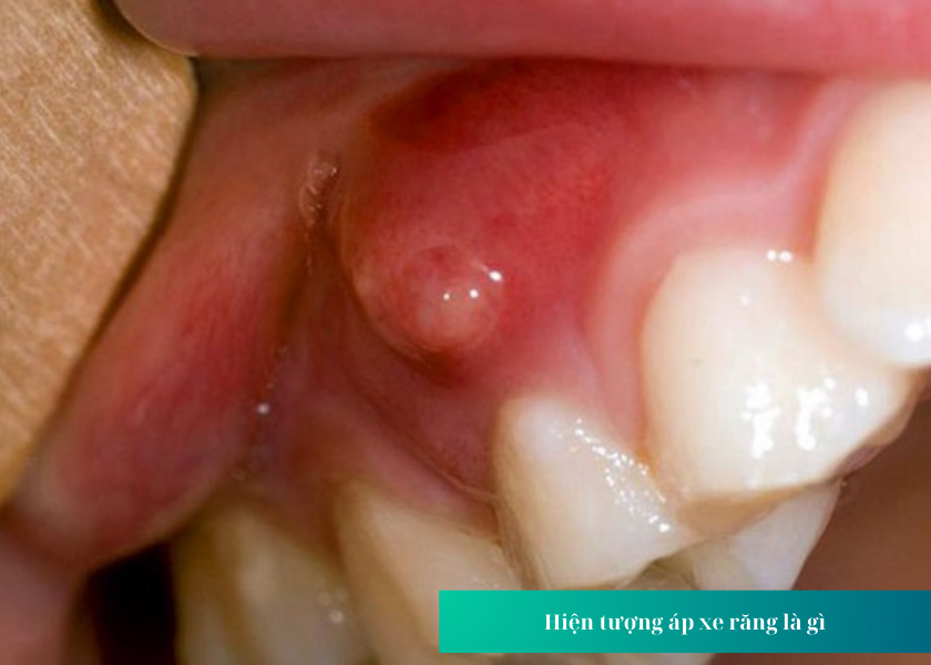 Hiện tượng áp xe răng là gì?