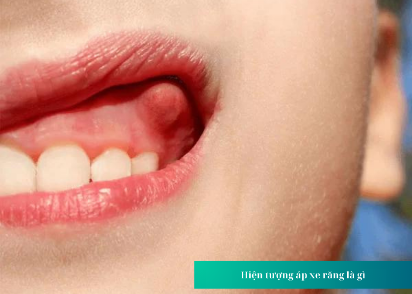 Dấu hiệu nhận biết áp xe xương ổ răng là gì?