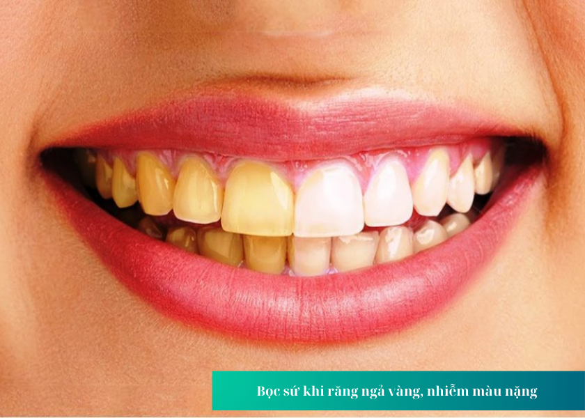 Bọc sứ khi răng ngả vàng, nhiễm màu nặng 