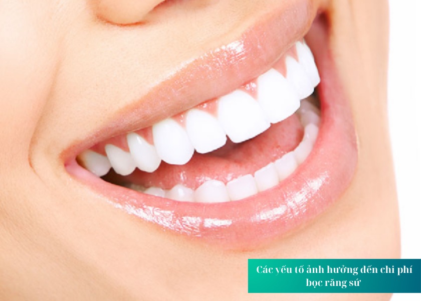 Các yếu tố ảnh hưởng đến chi phí bọc răng sứ 